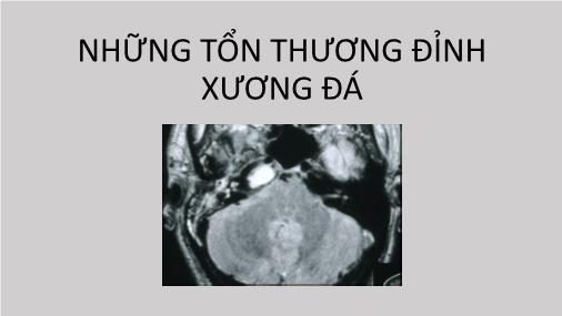 Bài giảng Những tổn thương đỉnh xương đá